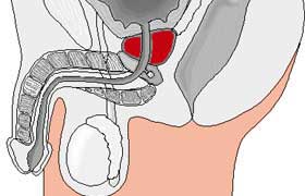 Le cancer de la prostate